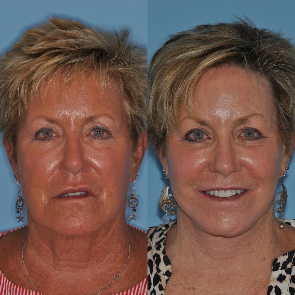 Facelift Before & After Gallery - Patient 186003 - Image 1
