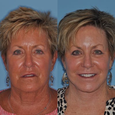 Facelift Before & After Gallery - Patient 186003 - Image 1