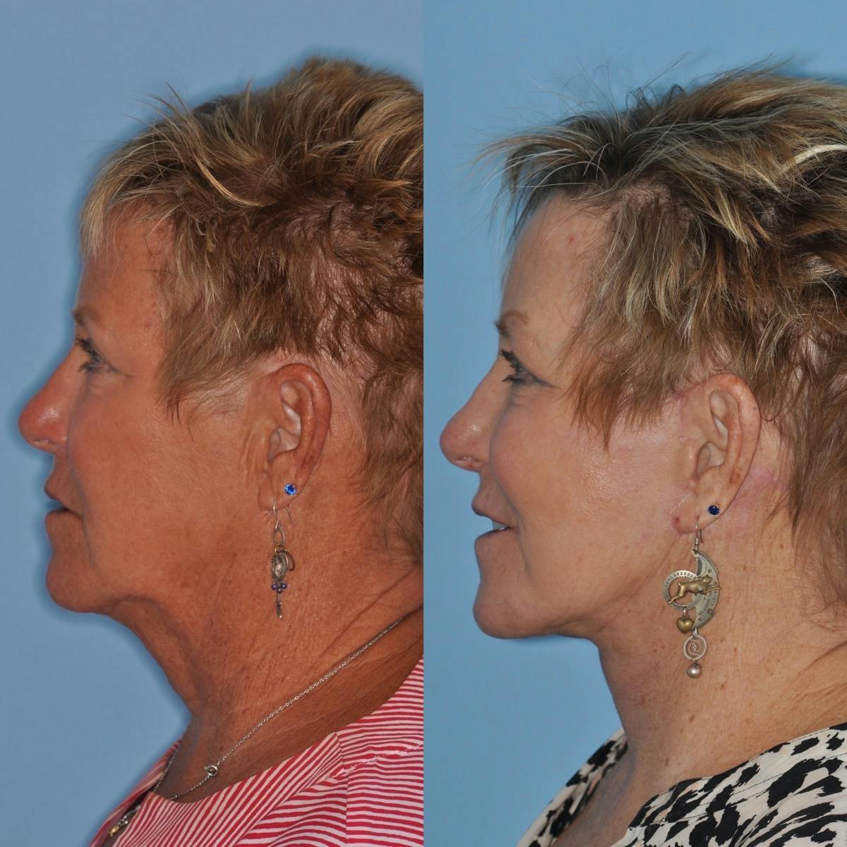 Facelift Before & After Gallery - Patient 186003 - Image 2