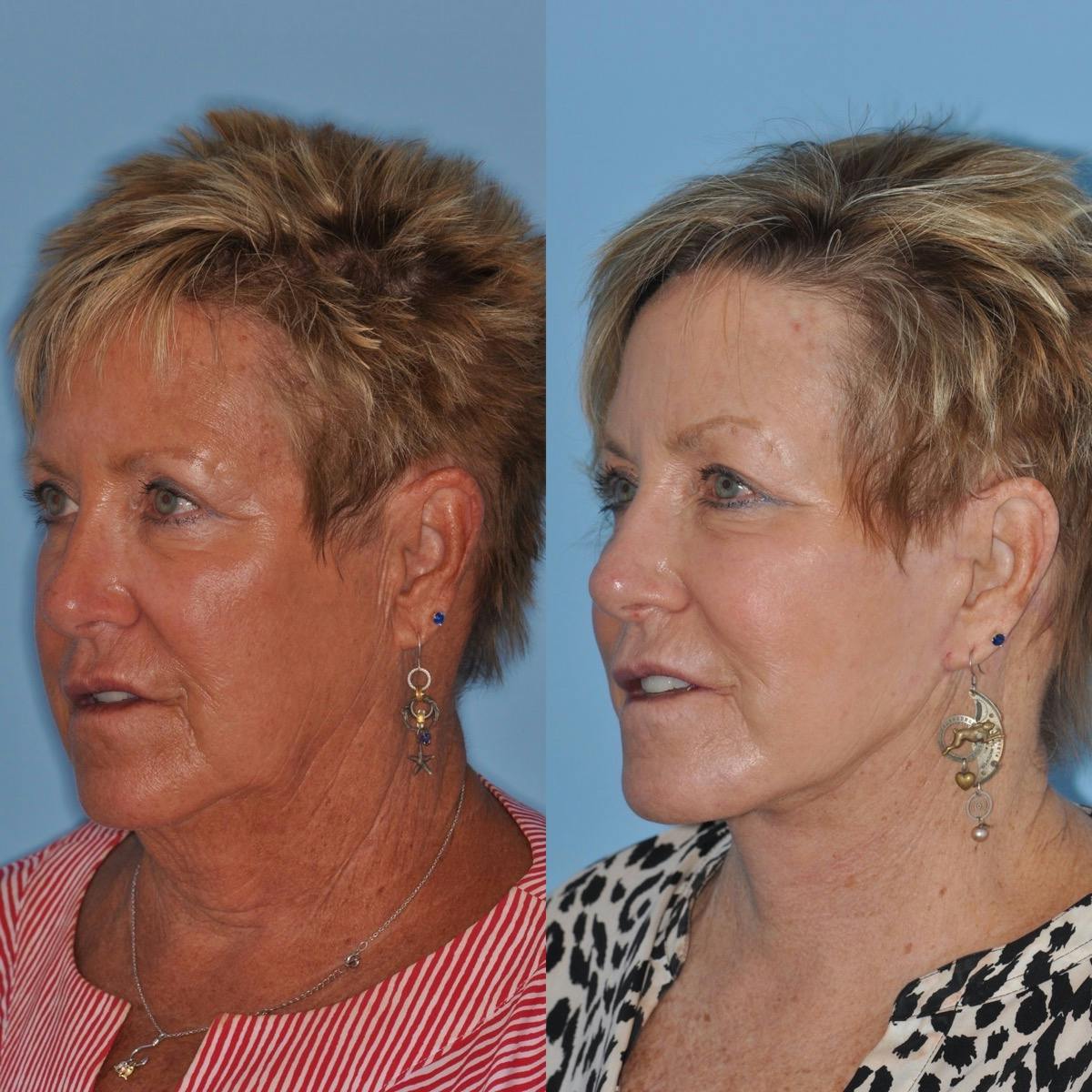 Facelift Before & After Gallery - Patient 186003 - Image 3