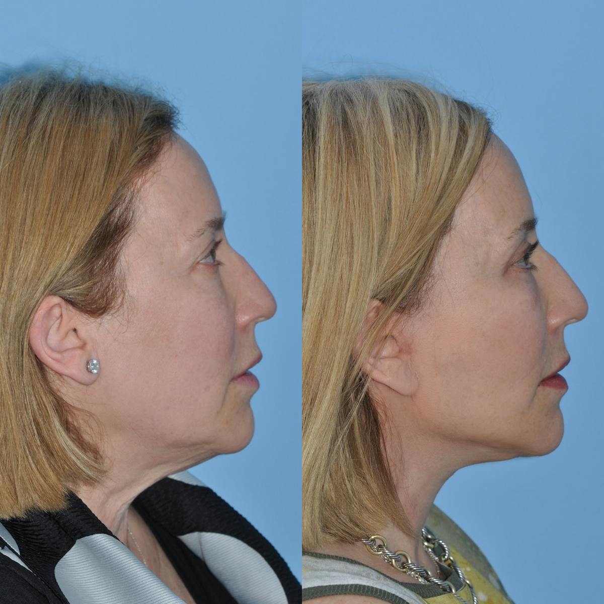 Facelift Before & After Gallery - Patient 383224 - Image 2