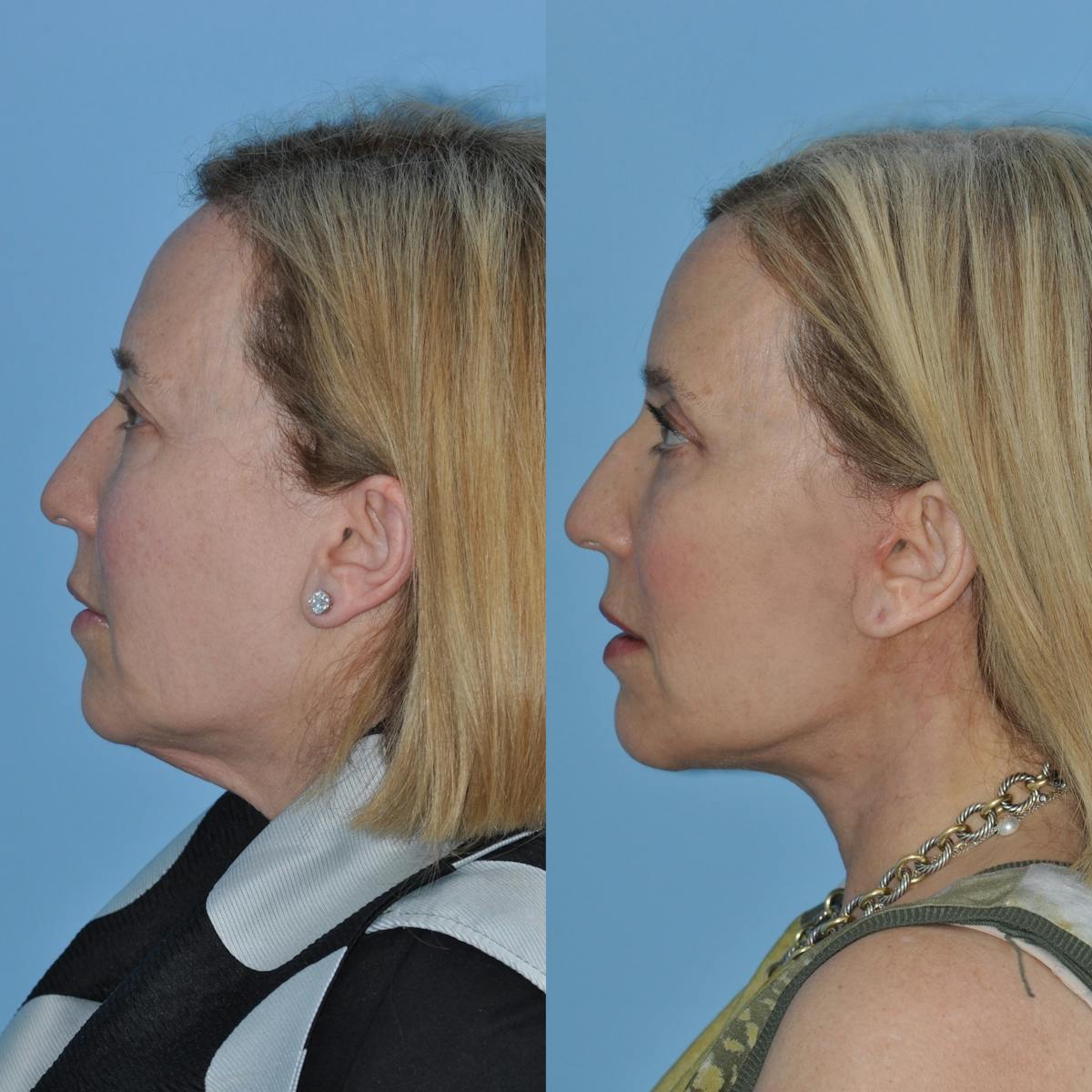 Facelift Before & After Gallery - Patient 383224 - Image 3