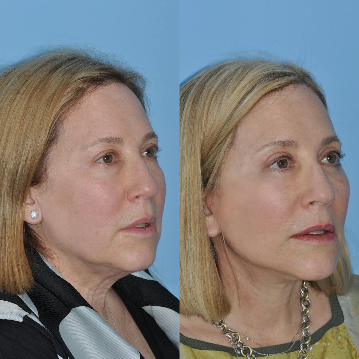 Facelift Before & After Gallery - Patient 383224 - Image 4