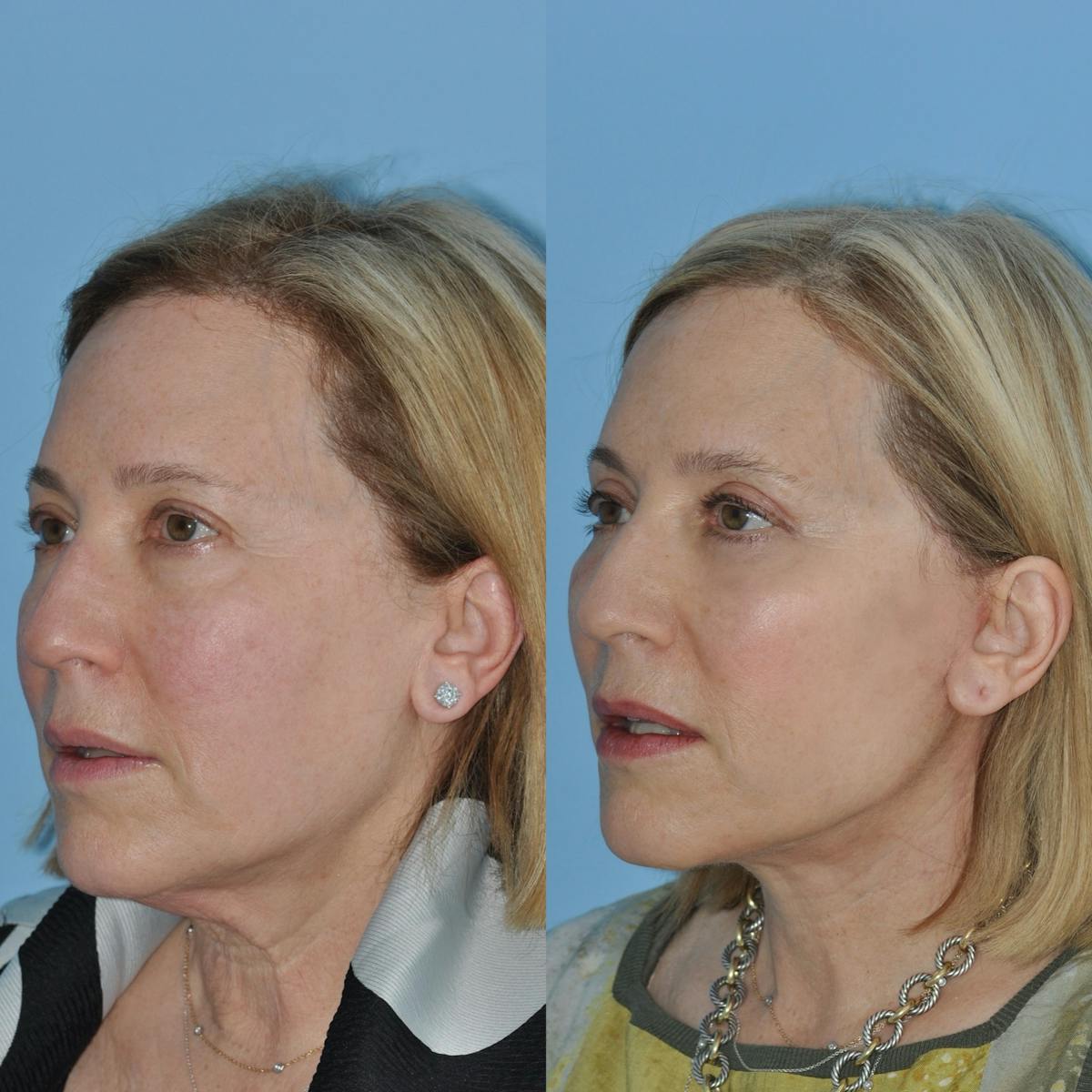 Facelift Before & After Gallery - Patient 383224 - Image 6