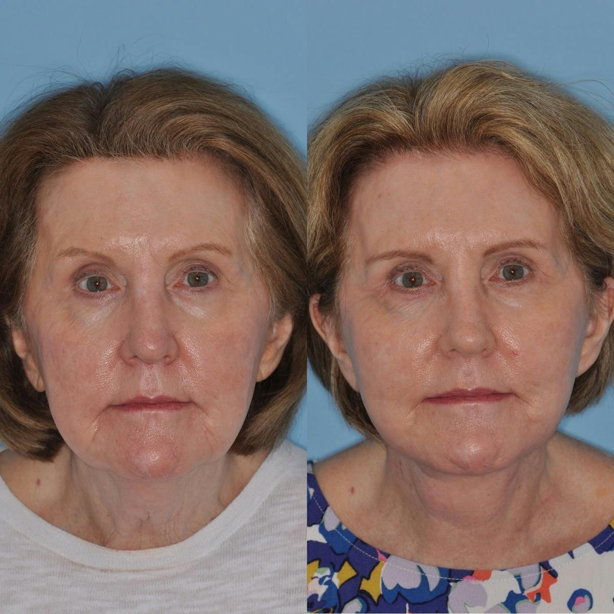 Facelift Before & After Gallery - Patient 385366 - Image 2