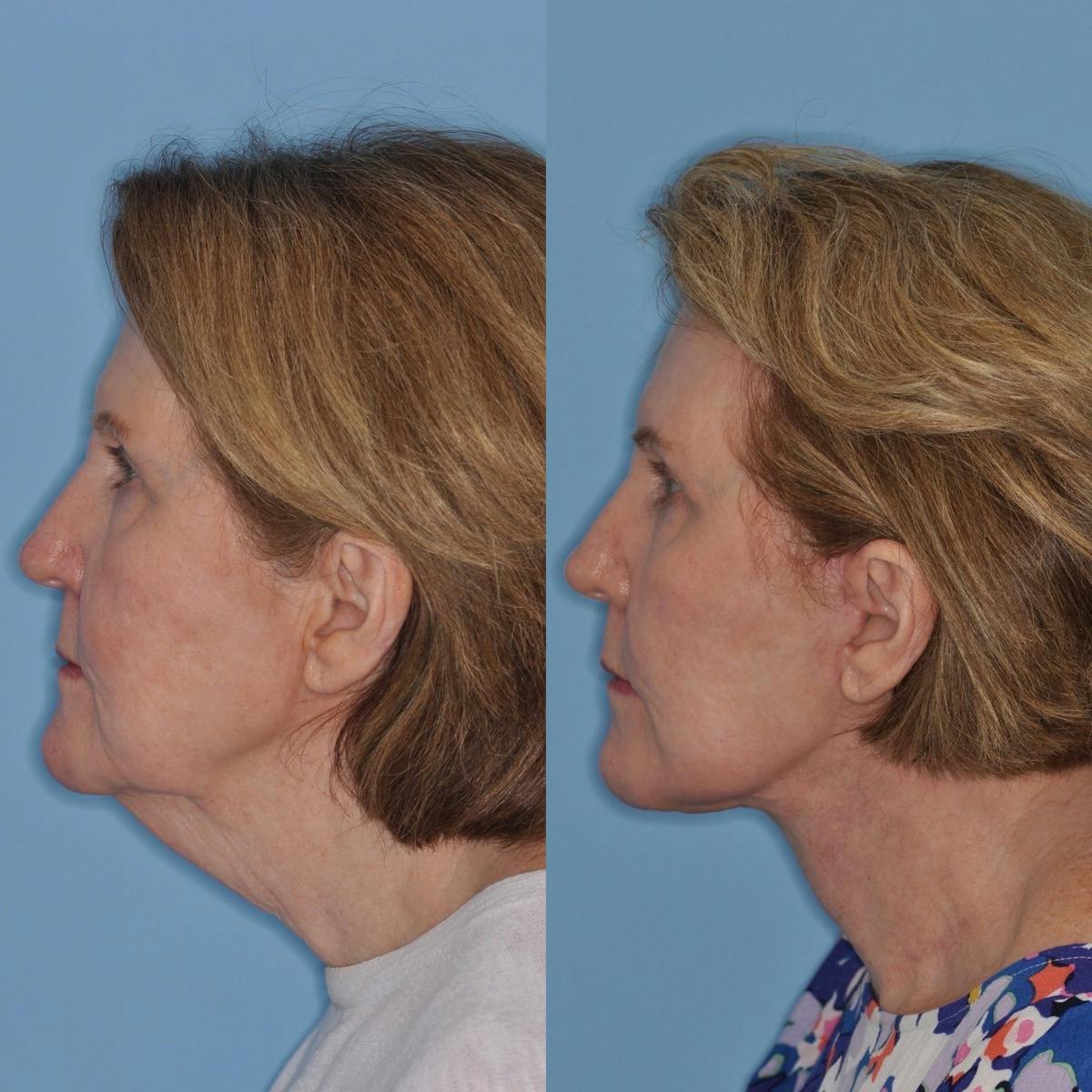 Facelift Before & After Gallery - Patient 385366 - Image 4