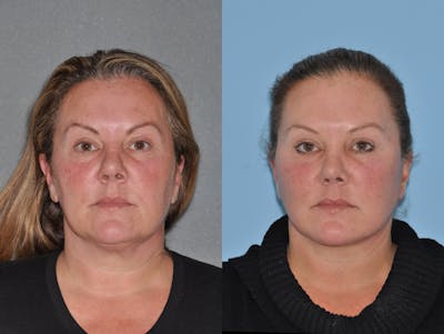 Facelift Before & After Gallery - Patient 347770 - Image 1