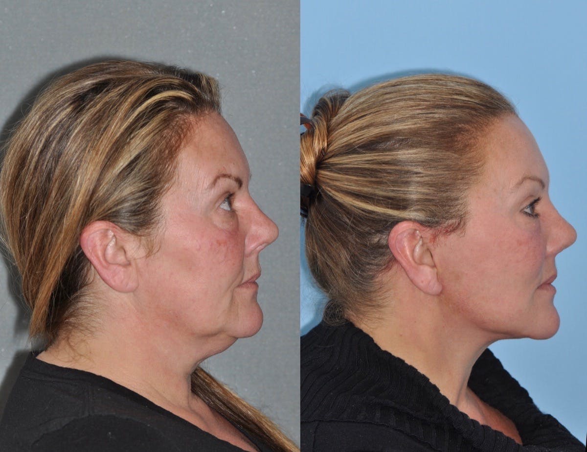 Facelift Before & After Gallery - Patient 347770 - Image 2