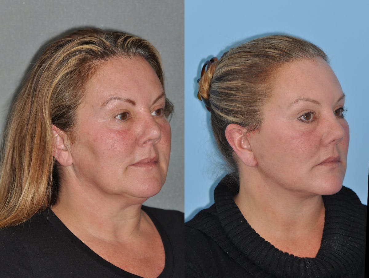 Facelift Before & After Gallery - Patient 347770 - Image 3