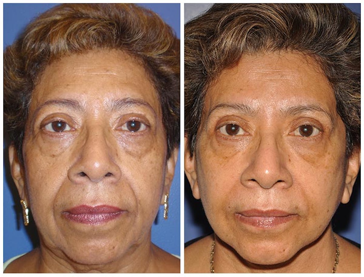 Facelift Before & After Gallery - Patient 223009 - Image 1