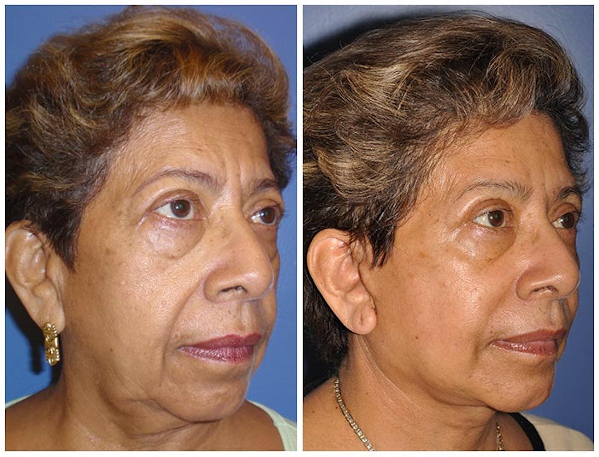 Facelift Before & After Gallery - Patient 223009 - Image 2