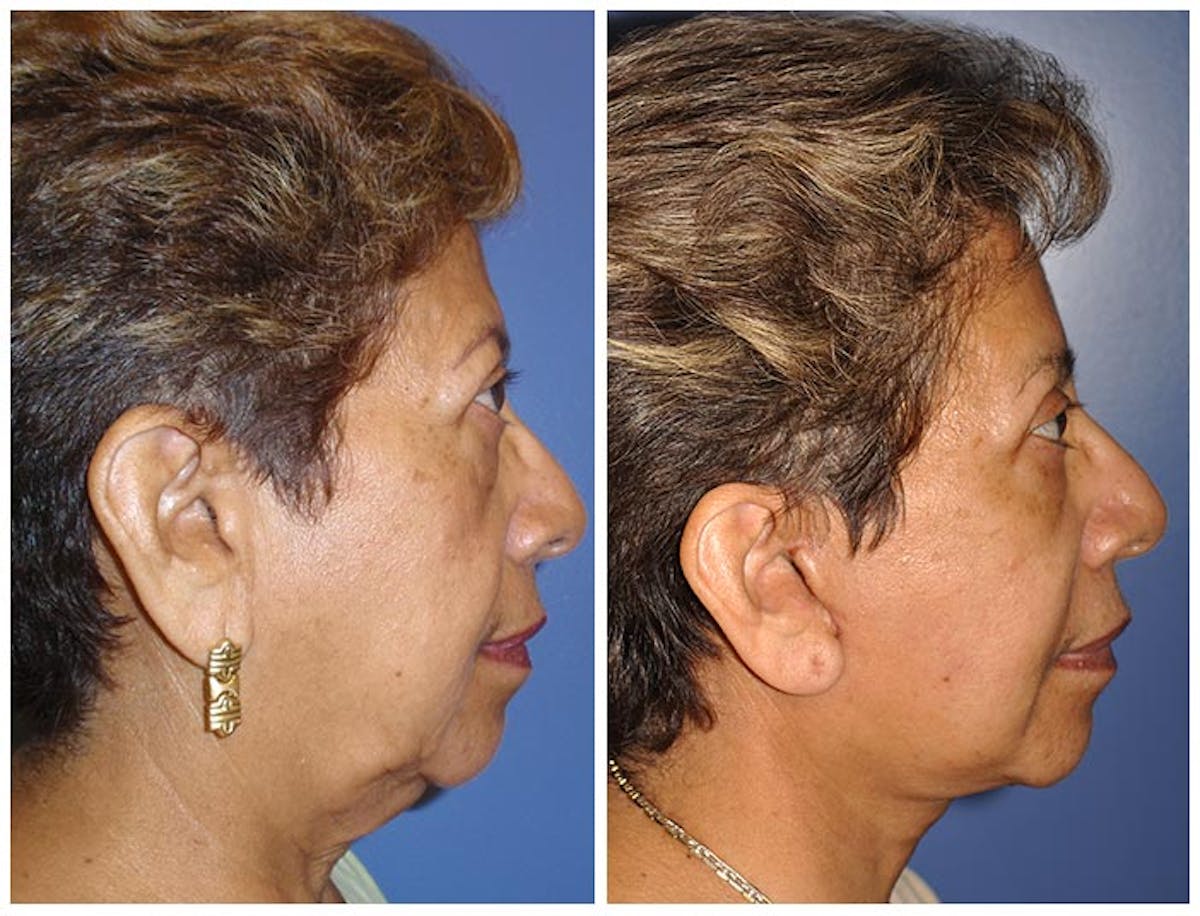 Facelift Before & After Gallery - Patient 223009 - Image 3
