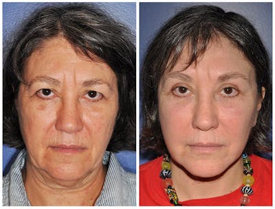 Facelift Before & After Gallery - Patient 328461 - Image 1