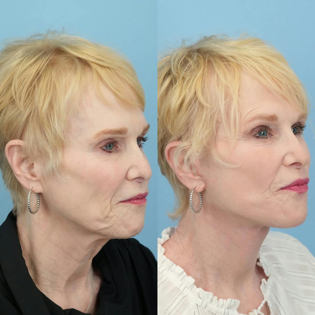 Facelift Before & After Gallery - Patient 333053 - Image 1