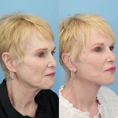 Facelift Before & After Gallery - Patient 333053 - Image 1