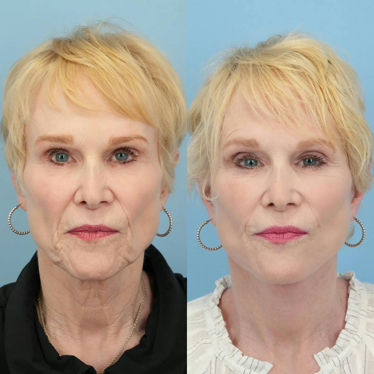 Facelift Before & After Gallery - Patient 333053 - Image 2