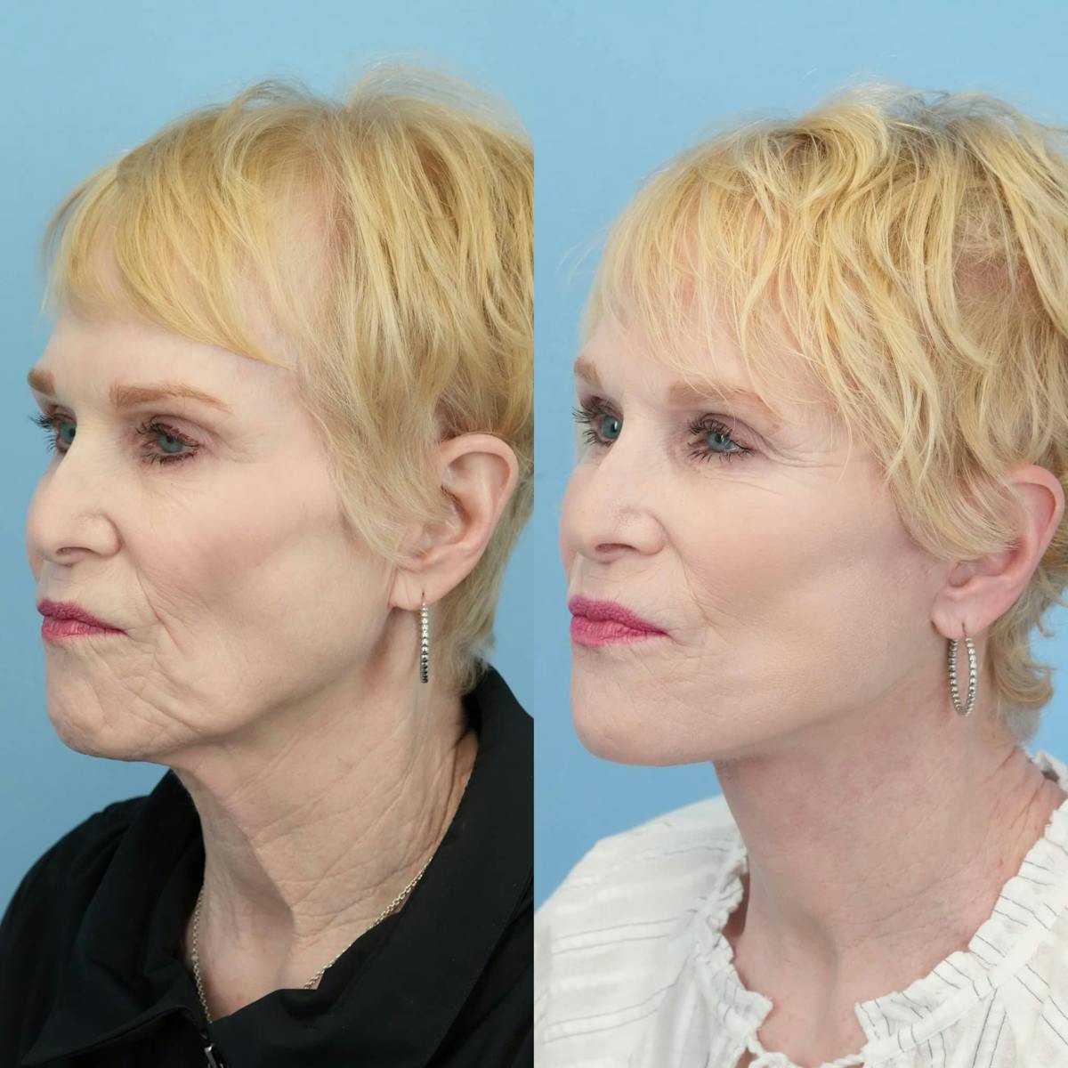 Facelift Before & After Gallery - Patient 333053 - Image 3