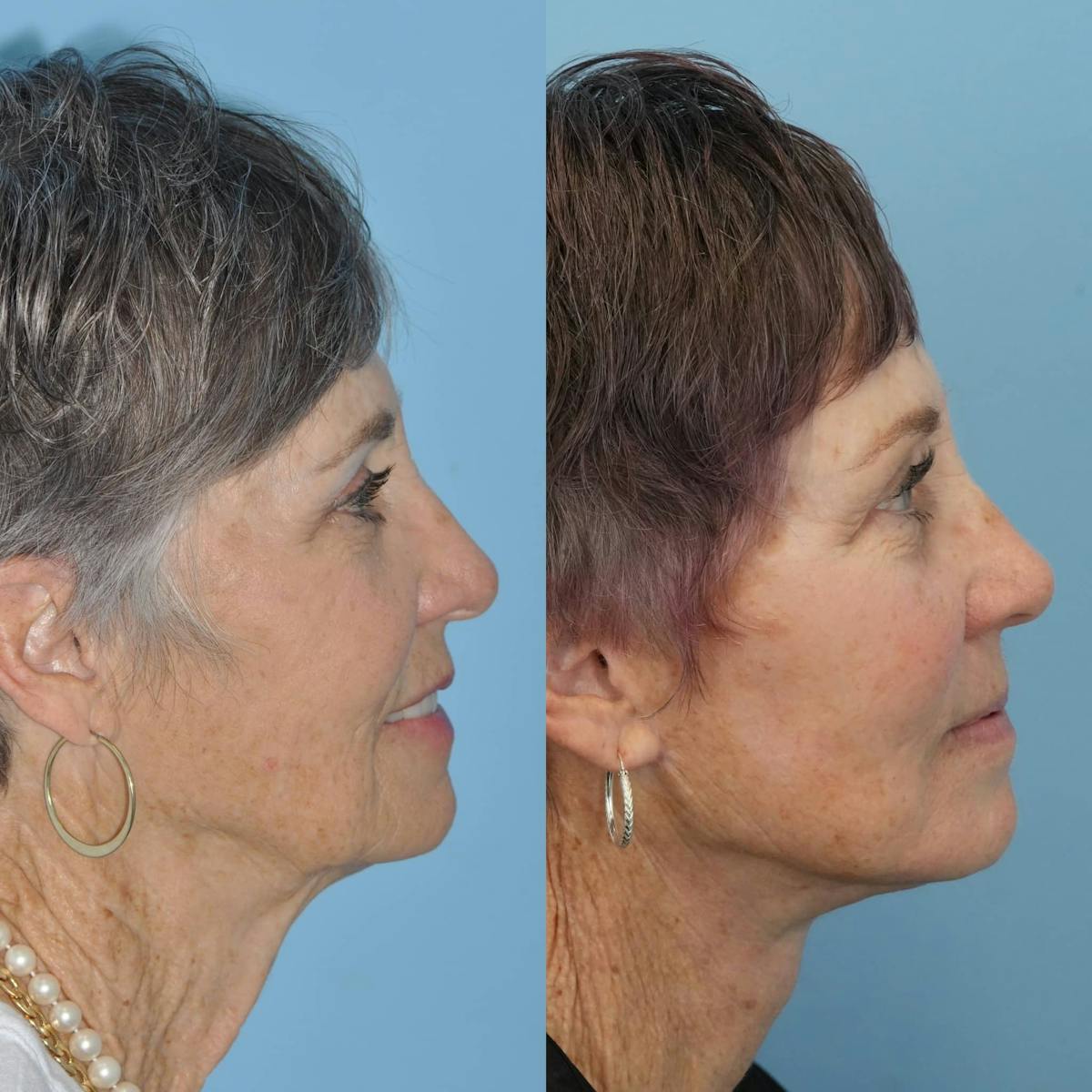 Facelift Before & After Gallery - Patient 397254 - Image 2