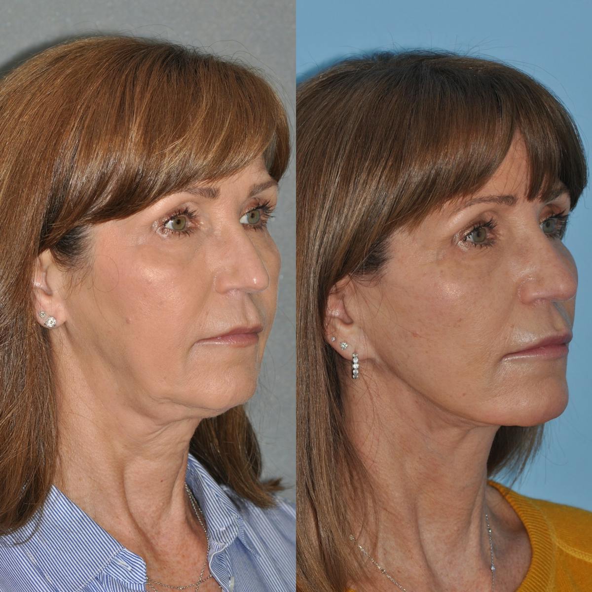 Facelift Before & After Gallery - Patient 127487 - Image 1