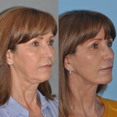 Facelift Before & After Gallery - Patient 127487 - Image 1