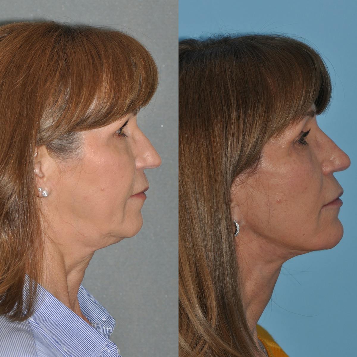 Facelift Before & After Gallery - Patient 127487 - Image 2