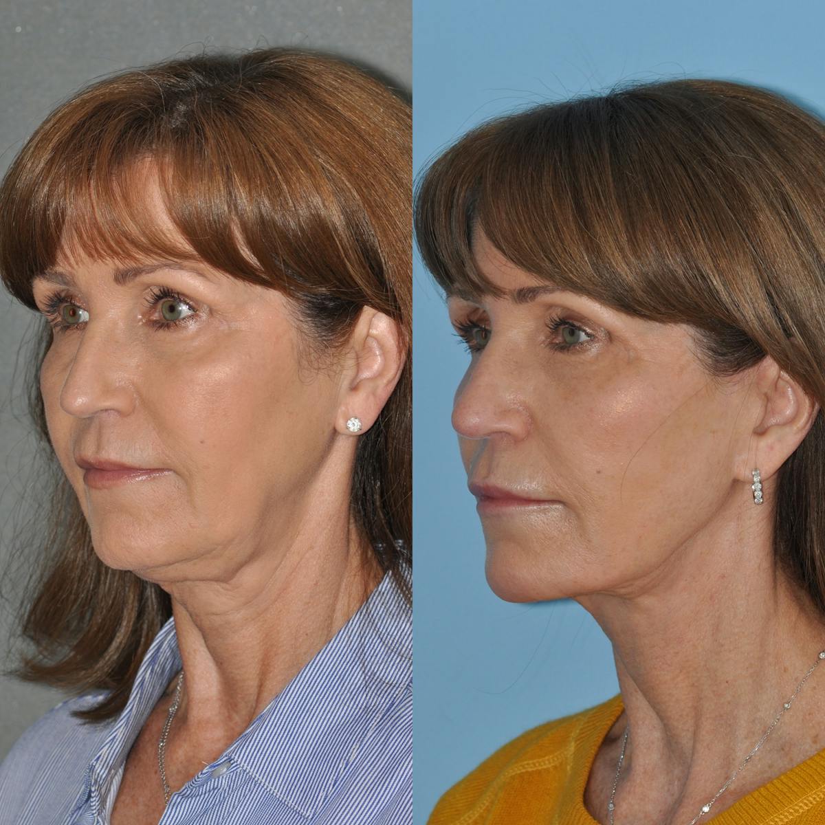 Facelift Before & After Gallery - Patient 127487 - Image 3