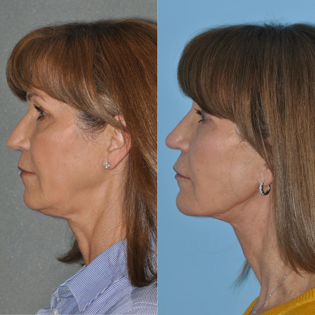 Facelift Before & After Gallery - Patient 127487 - Image 4