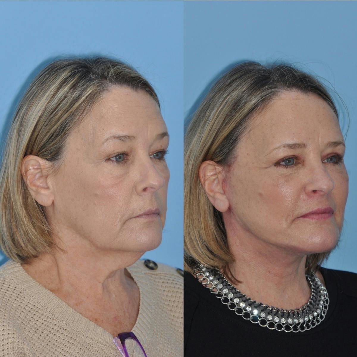 Facelift Before & After Gallery - Patient 144151 - Image 1