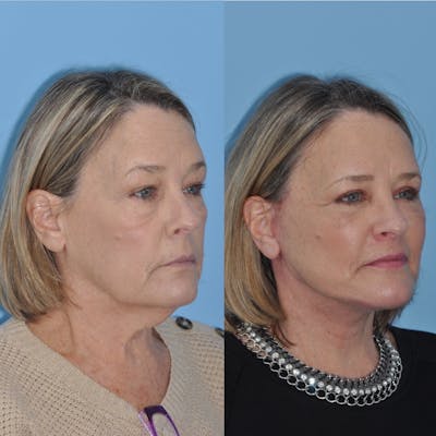 Facelift Before & After Gallery - Patient 144151 - Image 1