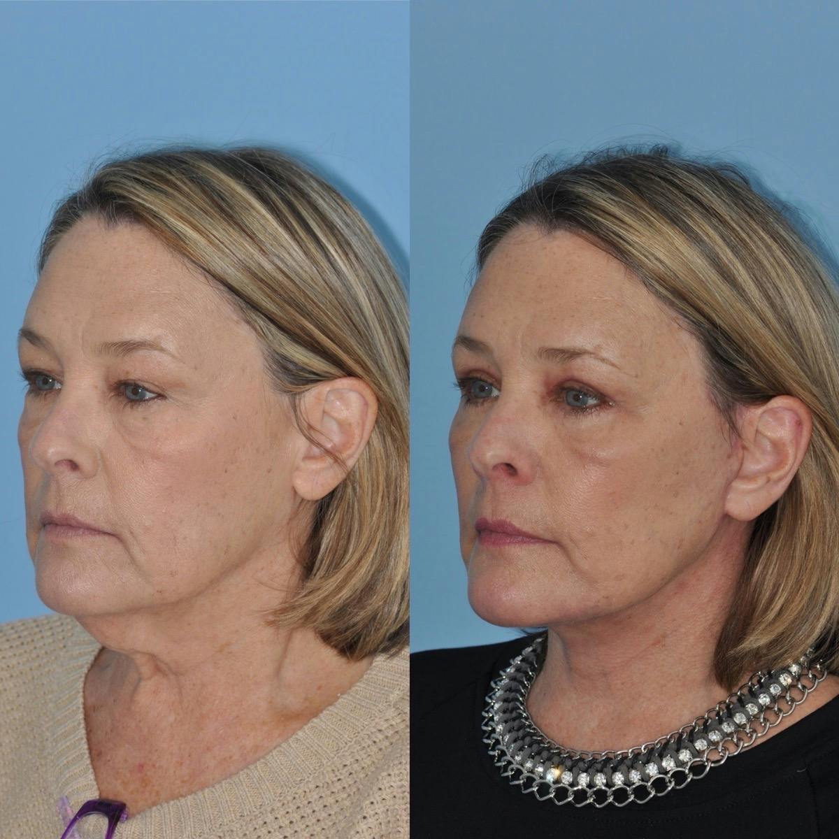 Facelift Before & After Gallery - Patient 144151 - Image 2