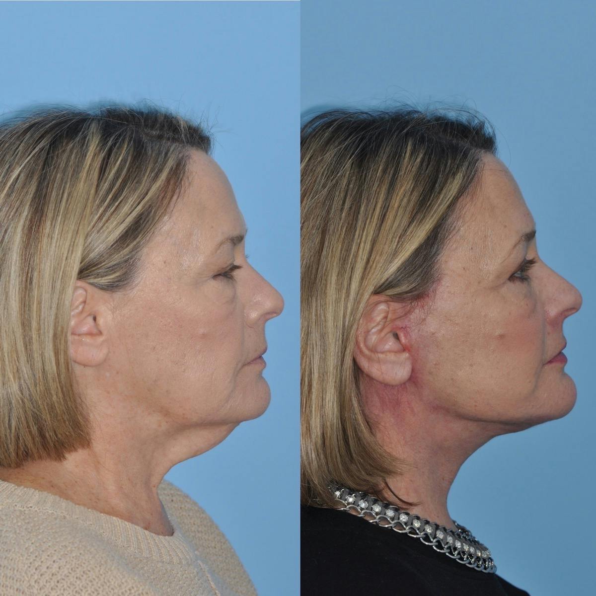 Facelift Before & After Gallery - Patient 144151 - Image 3