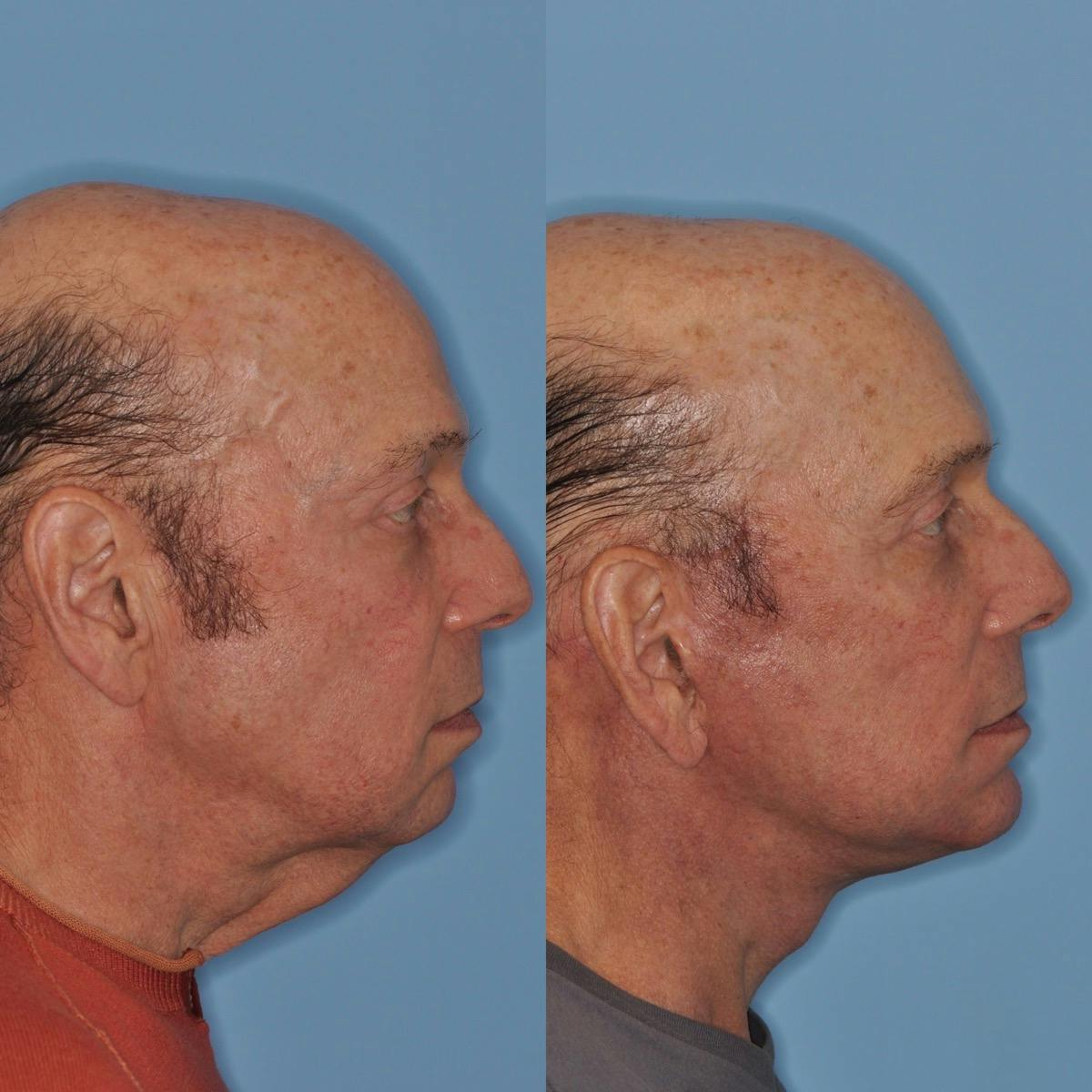 Facelift Before & After Gallery - Patient 173093 - Image 1