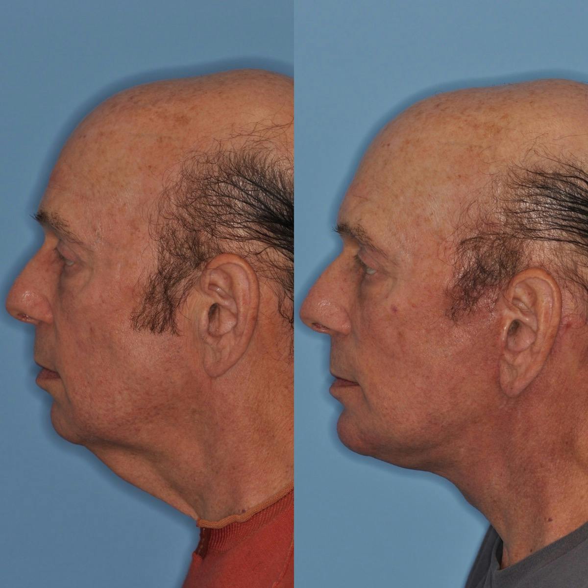 Facelift Before & After Gallery - Patient 173093 - Image 2