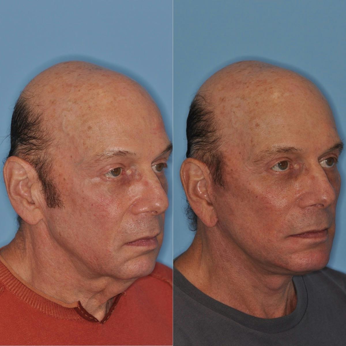 Facelift Before & After Gallery - Patient 173093 - Image 3