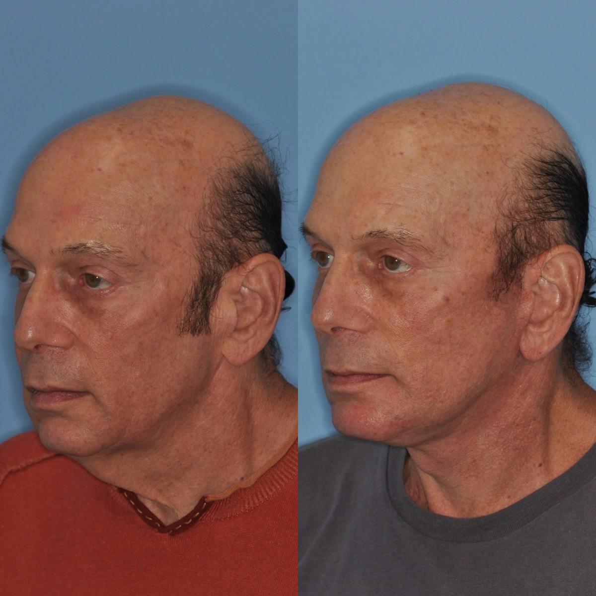 Facelift Before & After Gallery - Patient 173093 - Image 4