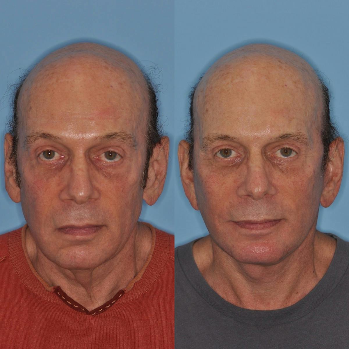 Facelift Before & After Gallery - Patient 173093 - Image 5