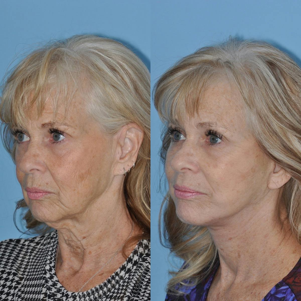 Facelift Before & After Gallery - Patient 264587 - Image 2