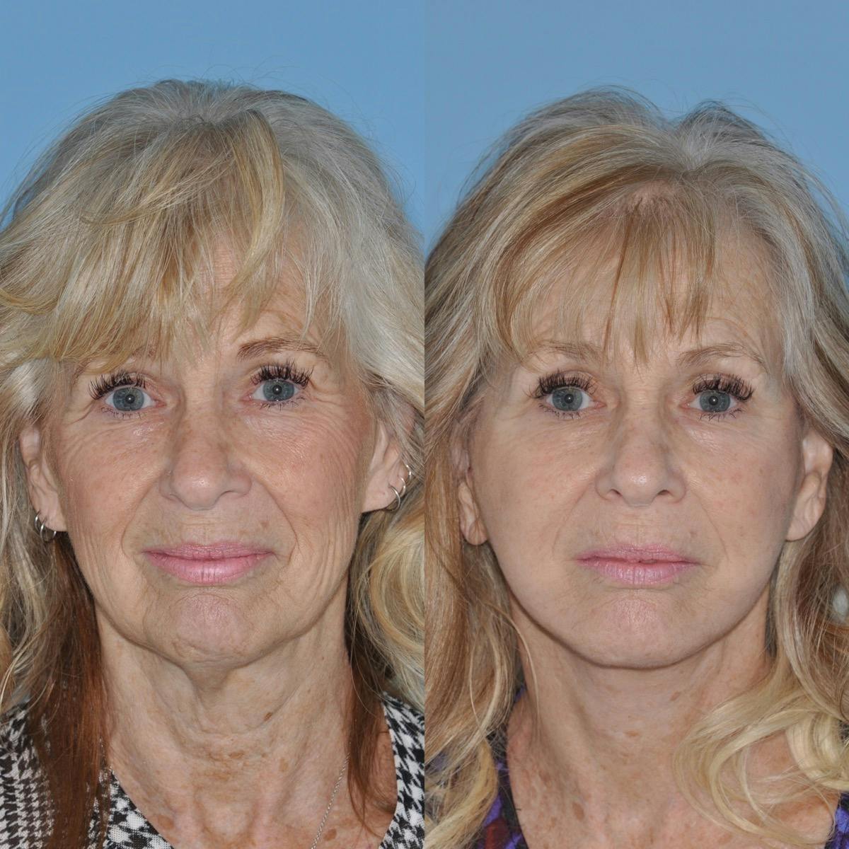 Facelift Before & After Gallery - Patient 264587 - Image 4