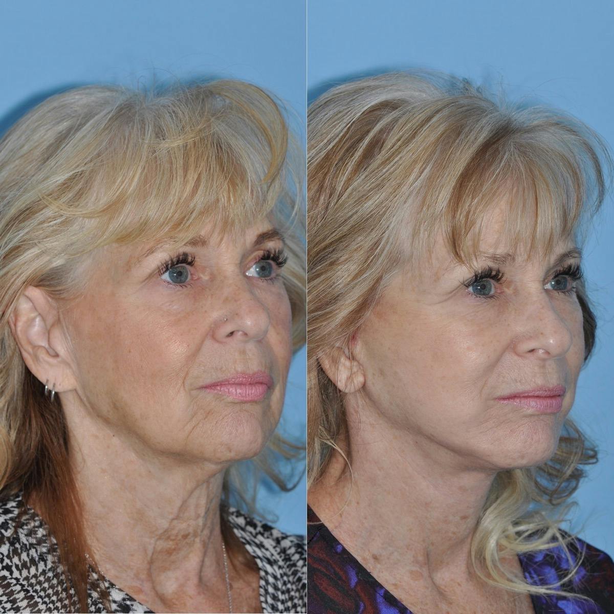 Facelift Before & After Gallery - Patient 264587 - Image 5