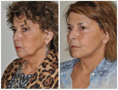 Facelift Before & After Gallery - Patient 270927 - Image 1