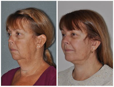 Facelift Before & After Gallery - Patient 395110 - Image 1