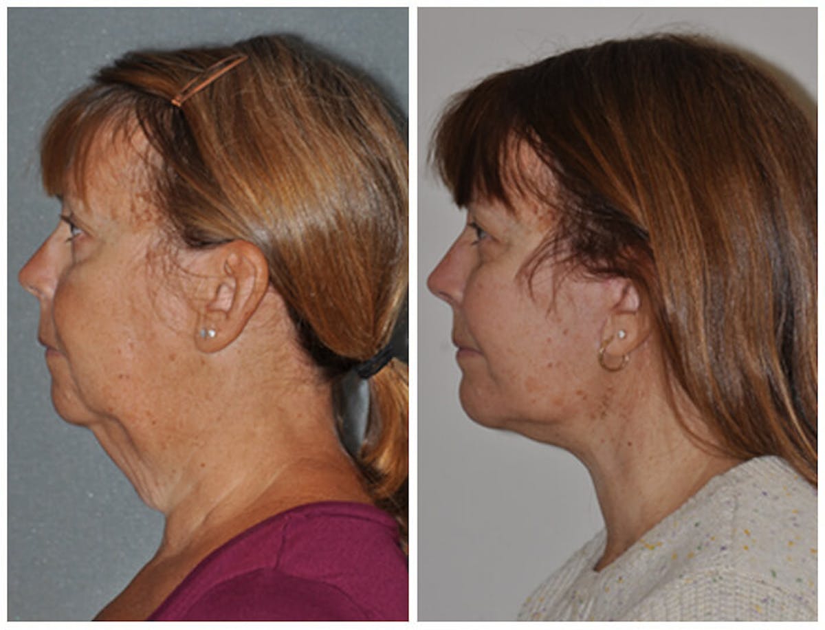 Facelift Before & After Gallery - Patient 395110 - Image 2