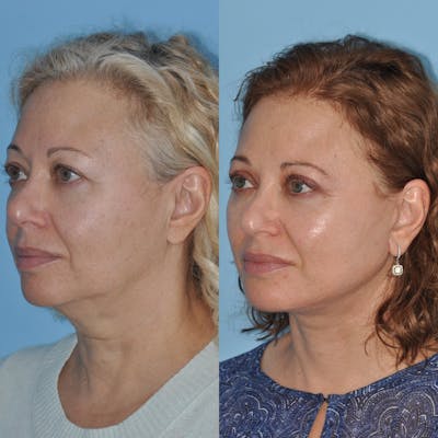 Facelift Before & After Gallery - Patient 349651 - Image 1