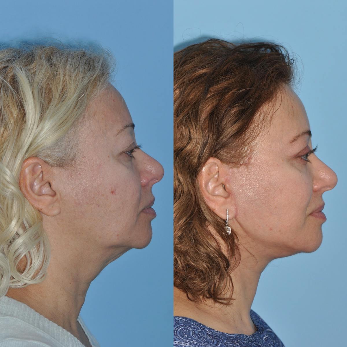 Facelift Before & After Gallery - Patient 349651 - Image 2