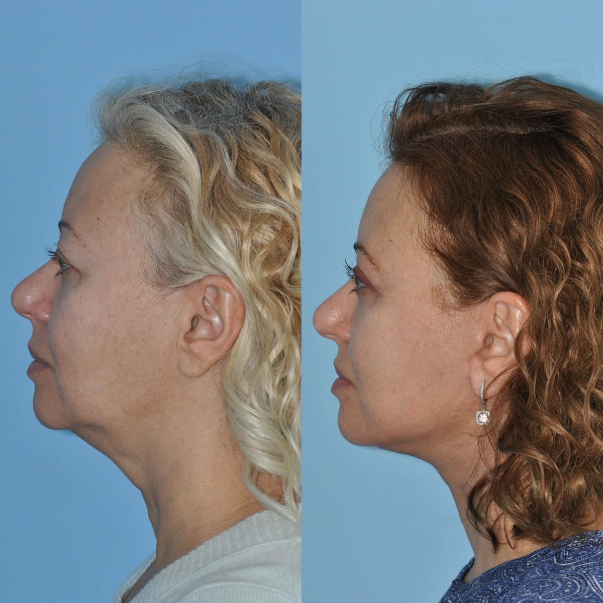 Facelift Before & After Gallery - Patient 349651 - Image 3