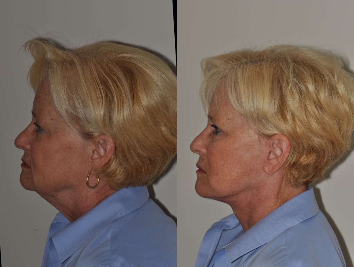 Facelift Before & After Gallery - Patient 250474 - Image 1