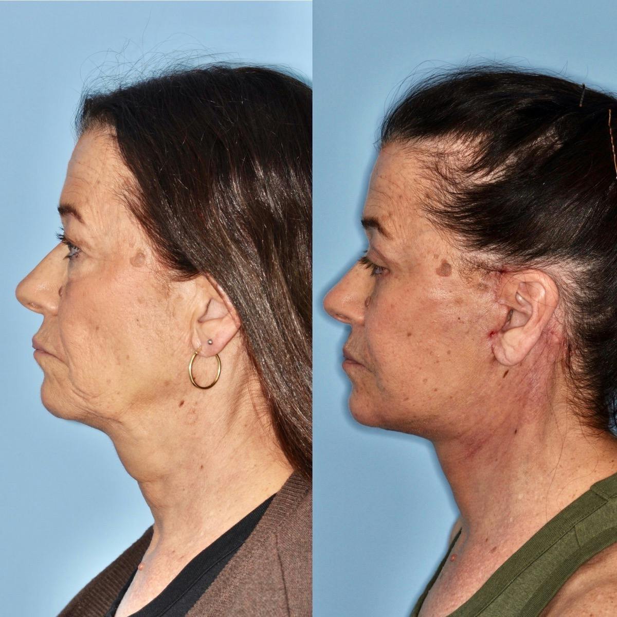 Facelift Before & After Gallery - Patient 370691 - Image 1