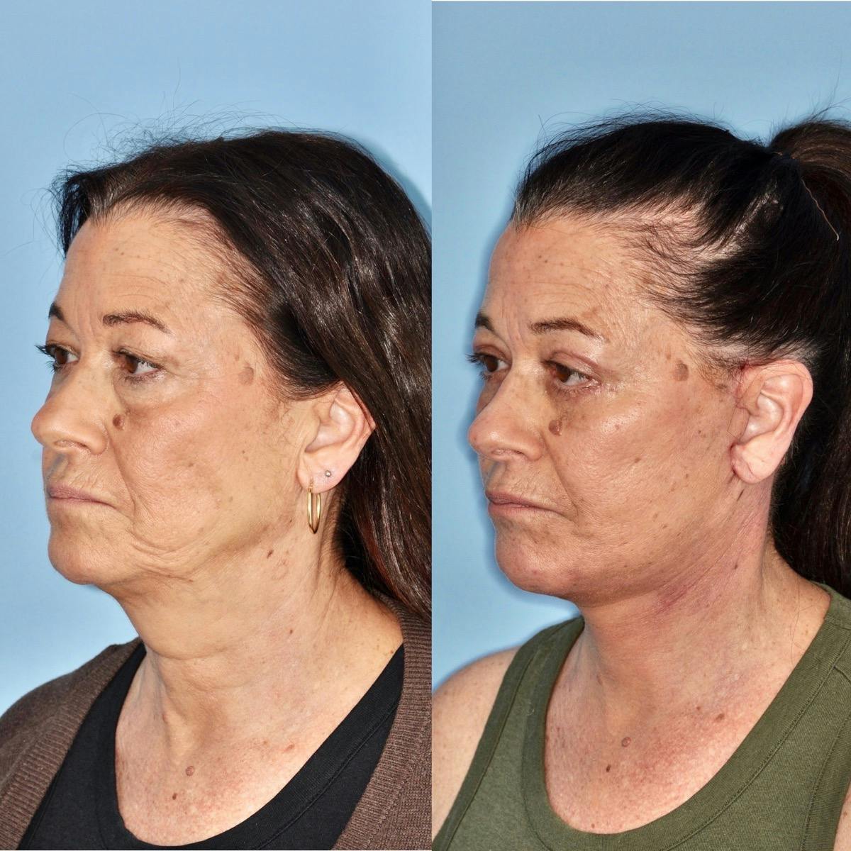 Facelift Before & After Gallery - Patient 370691 - Image 2