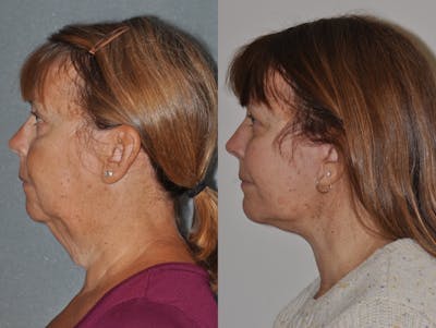 Facelift Before & After Gallery - Patient 347344 - Image 1