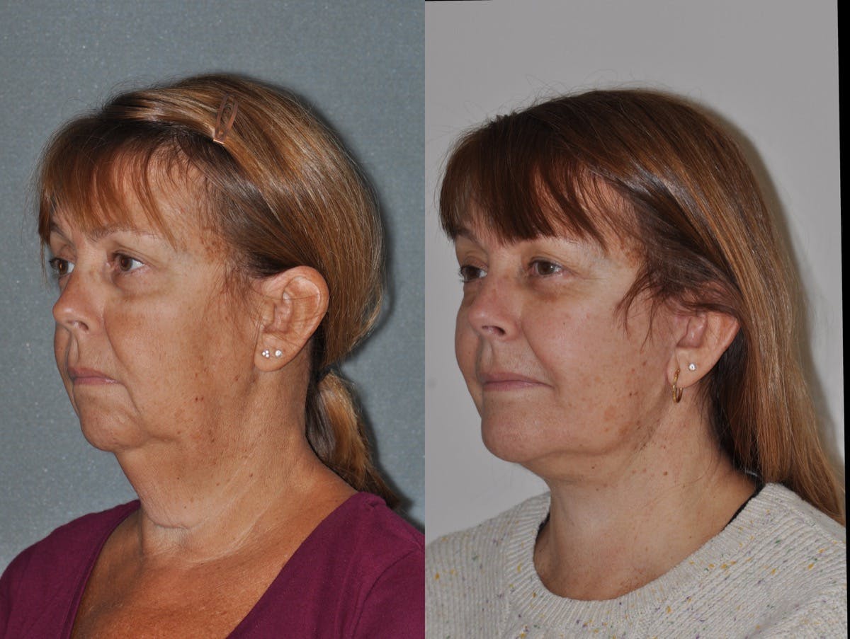 Facelift Before & After Gallery - Patient 347344 - Image 2